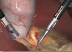 Simbionix LAP Mentor Laparoscopy Cholecystectomy Procedure Module