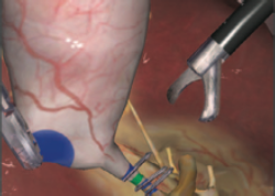 Simbionix LAP Mentor Laparoscopy Cholecystectomy Tasks Module